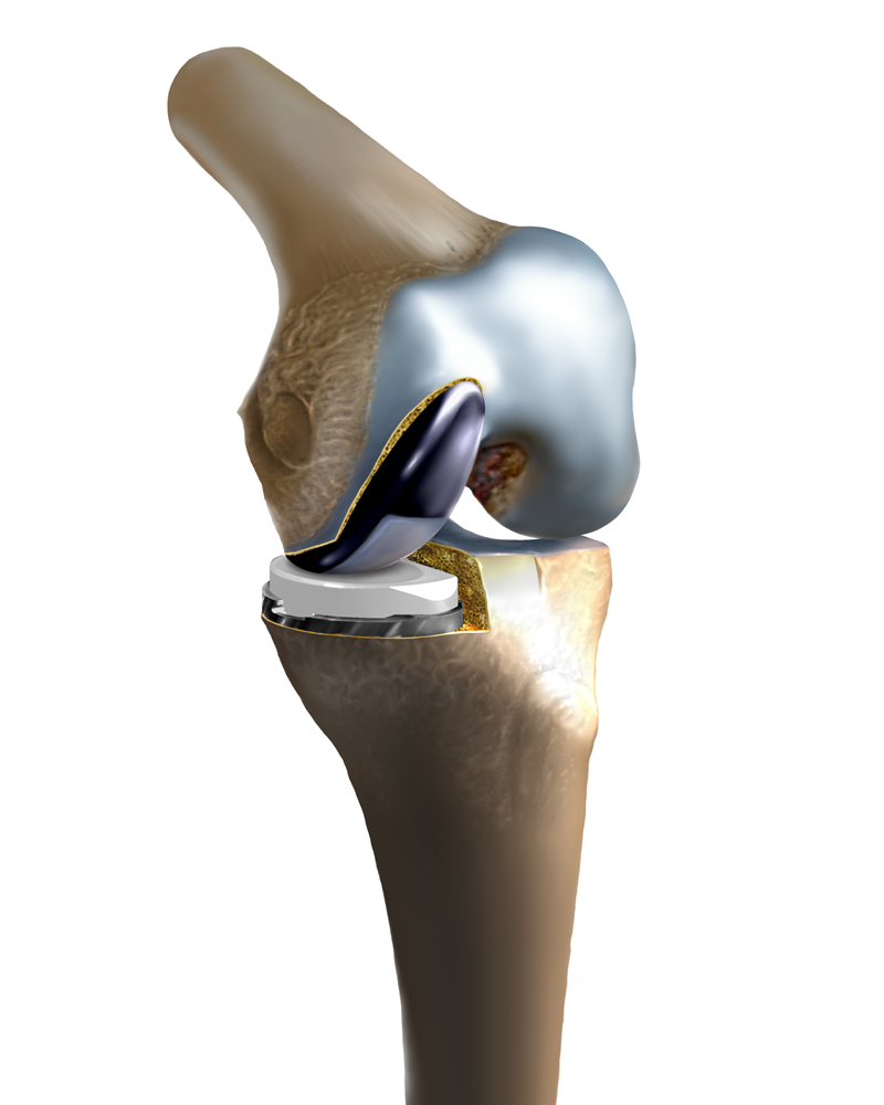 Unicompartmental Knee Illustration