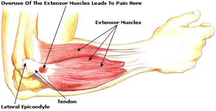 tennis-elbow-1