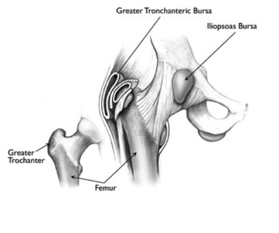 Trochanteric bursitis