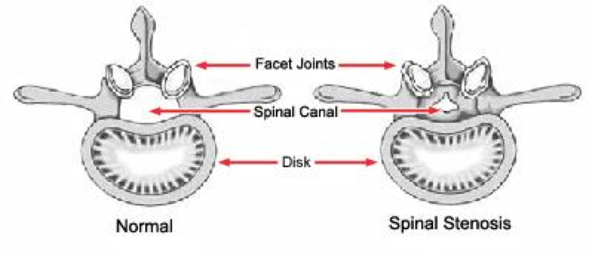 Spinal Stenosis - Ortho Illinois