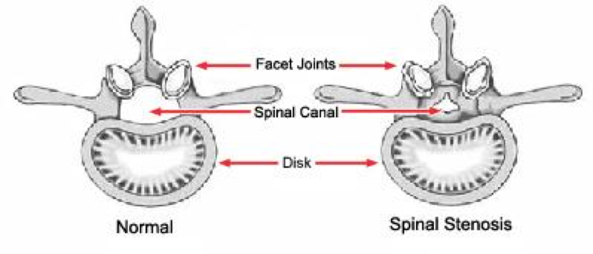 https://www.orthoillinois.com/wp-content/uploads/2019/05/Spinal-Stenosis-1.png